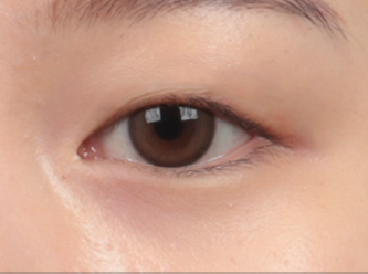 correction surgery 2 1 mo
