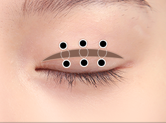 correction surgery 2 3 mo