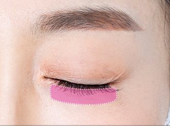 Blepharoplasty 50 e lower step 01 mo