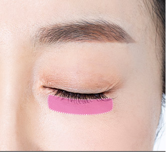 Blepharoplasty 49 e lower step 01 pc