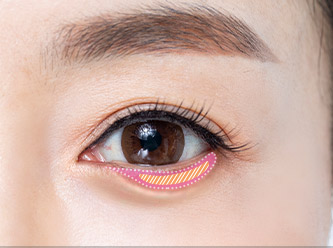 Blepharoplasty 52 e lower step 02 mo