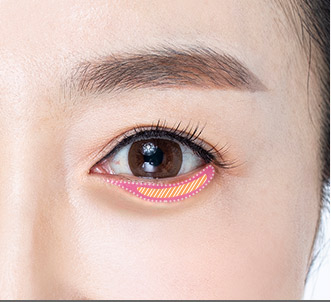 Blepharoplasty 51 e lower step 02 pc