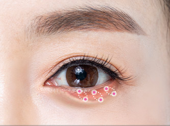 Blepharoplasty 54 e lower step 03 mo