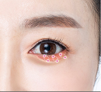 Blepharoplasty 53 e lower step 03 pc