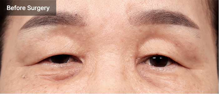 Blepharoplasty 59 e qna 01 mo