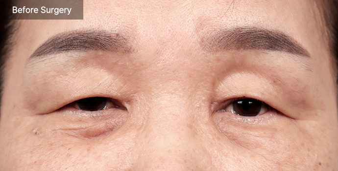 Blepharoplasty 57 e qna 01 pc