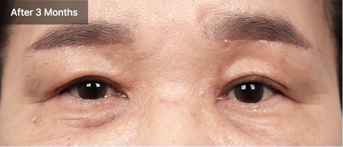 Blepharoplasty 60 e qna 02 mo