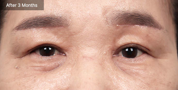 Blepharoplasty 58 e qna 02 pc