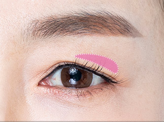 Blepharoplasty 42 e upper step 01 mo