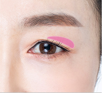 Blepharoplasty 41 e upper step 01 pc