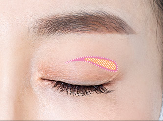 Blepharoplasty 44 e upper step 02 mo