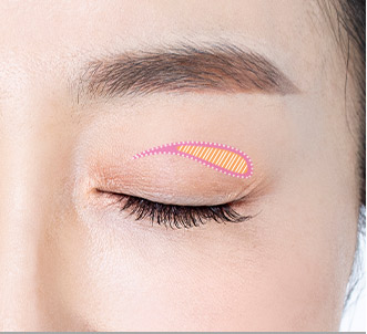 Blepharoplasty 43 e upper step 02 pc