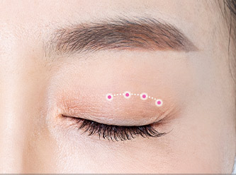 Blepharoplasty 46 e upper step 03 mo