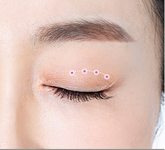 Blepharoplasty 45 e upper step 03 pc