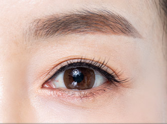 Blepharoplasty 48 e upper step 04 mo