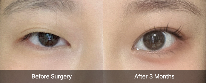 eye correction view right