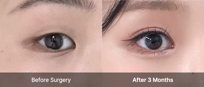 Natural Adhesion 25 eye natural view right mo