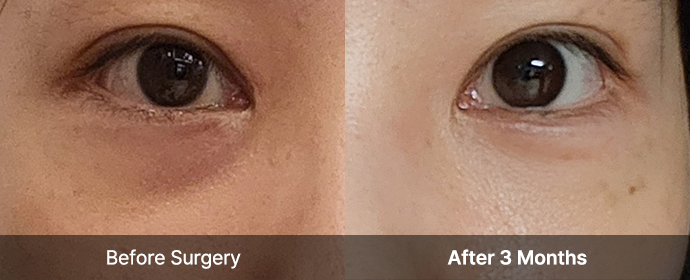 Under Eye Fat Reposition 25 eye province view right