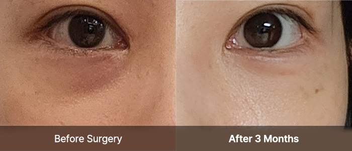 Under Eye Fat Reposition 26 eye province view right mo