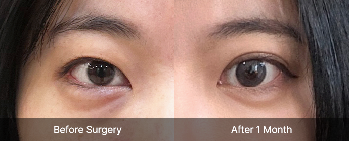 eye reoperation view right