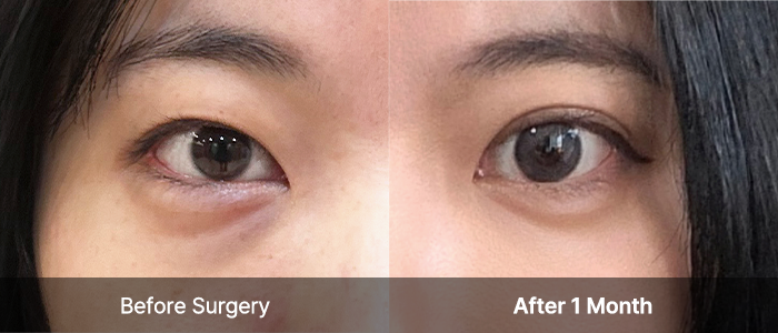 eye reoperation view right mo