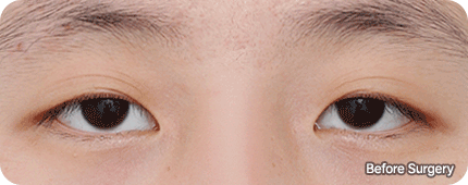 gif main ptosis