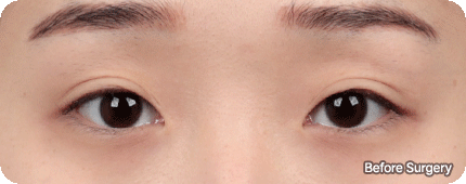 gif main re eyelid