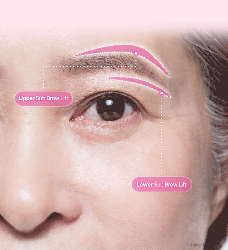 mo recommendation browlift gif