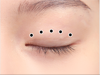 Natural Adhesion 35 natural surgery 1 mo