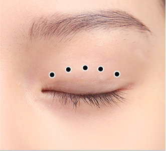 Natural Adhesion 34 natural surgery 1 pc