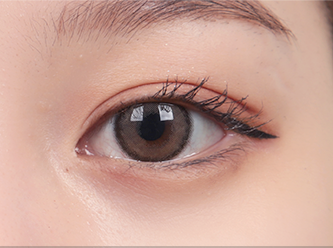 Natural Adhesion 41 natural surgery 4 mo