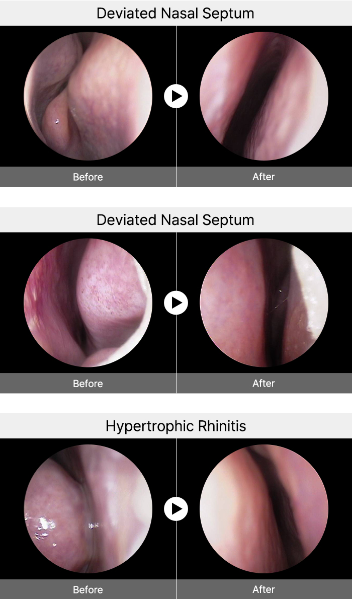 nose 3dct single2 mo