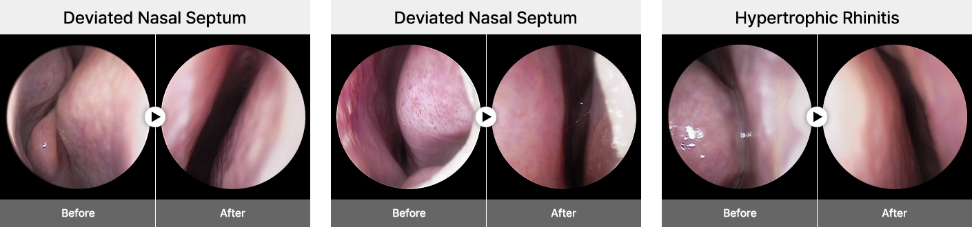 nose 3dct single2 pc