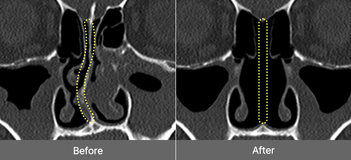 nose 3dct single mo