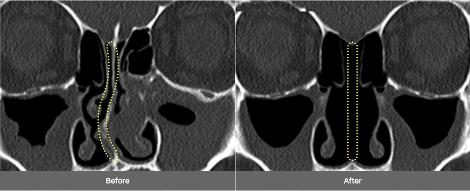 nose 3dct single pc