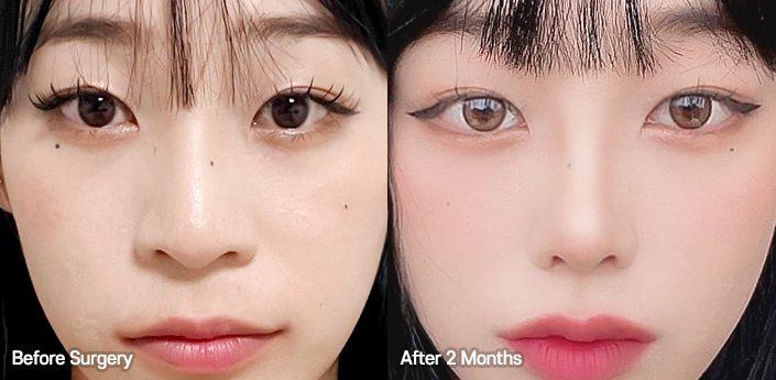 nose alar case 01