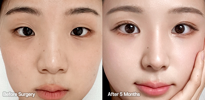 nose alar case 02