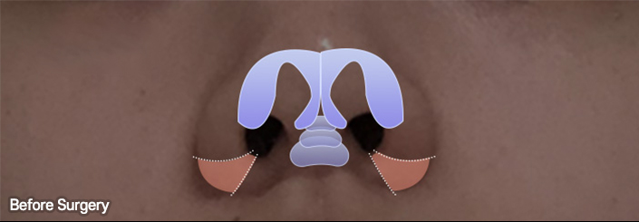 nose alar case 03