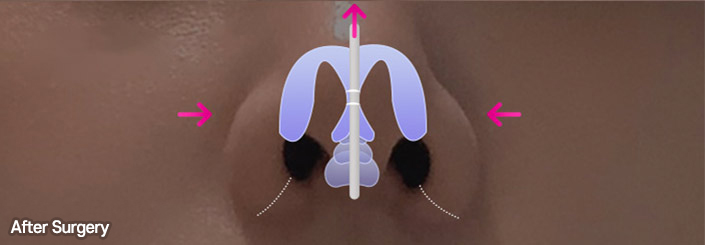 nose alar case 04