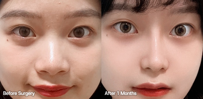 nose alar case 05