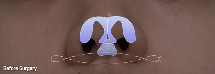 nose alar case 07