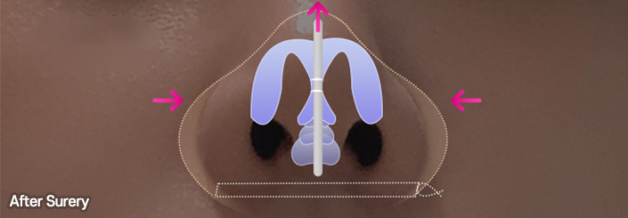 nose alar case 08