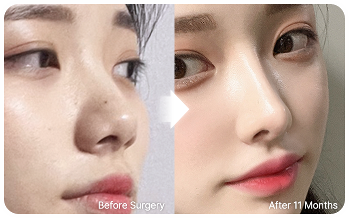 nose implants selfi 02