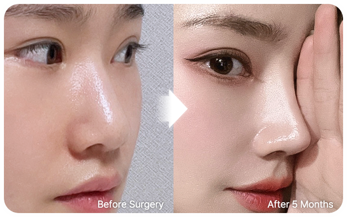 nose implants selfi 03