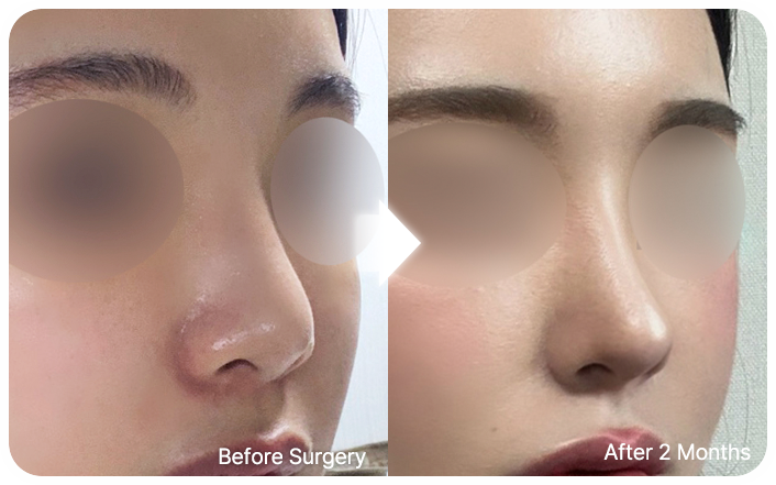 nose implants selfi 04