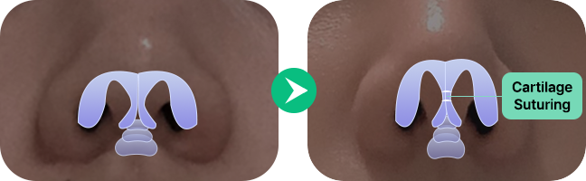 nose not implants method left 1 mo