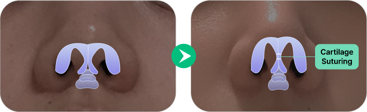nose not implants method left 1 pc