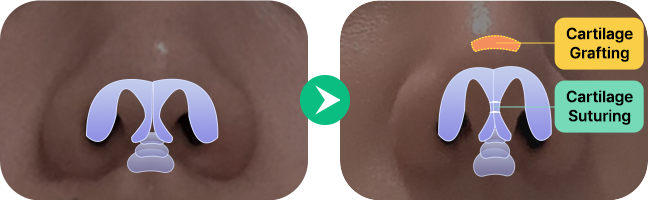 nose not implants method left 2 mo