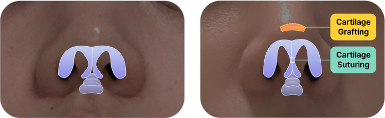 nose not implants method left 2 pc