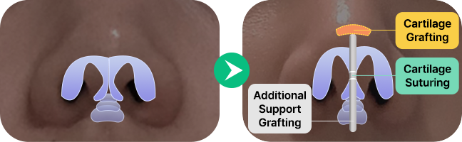 nose not implants method left 3 mo